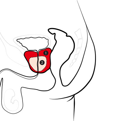 前立腺の位置と、肥大した前立腺のイメージ図